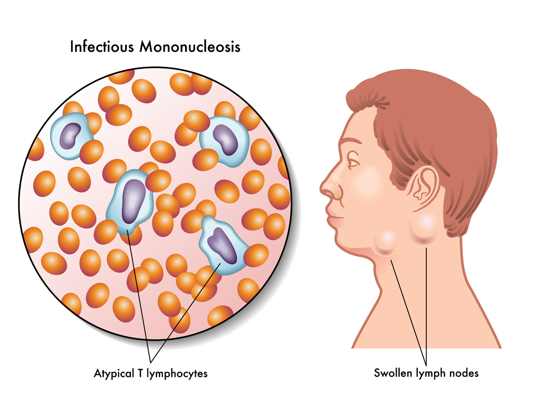 Mononucleosis Infection  Causes of Mono & Common Questions