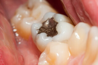 Should You Replace Your Old Silver Fillings?