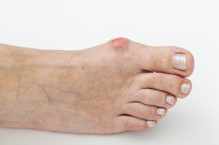 Bunions: Symptoms and Treatments