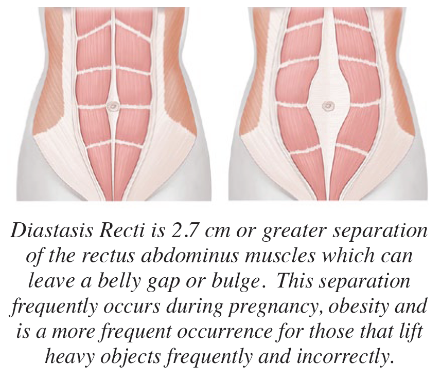Physical therapy to heal rectus diastasis — New Journey Physical
