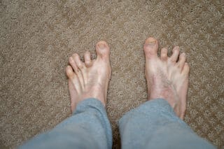 Hammertoes: Pain Of the Small Toes