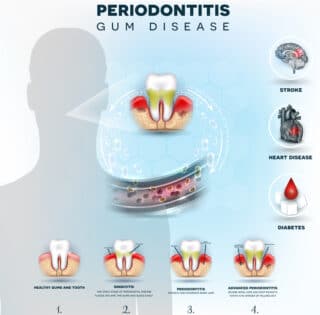 Periodontal Therapy For the Diabetic Patient