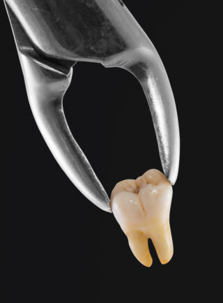 Are Tooth Extractions Helpful?