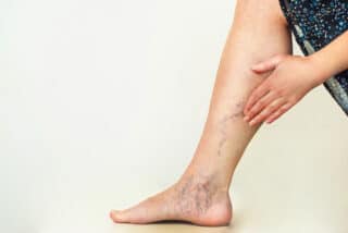 You Don’t Have To Suffer With Leg Veins