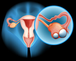 Ovarian Cancer Prevention