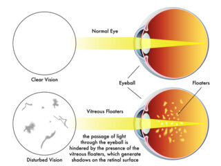 Eye Floaters: Treatment Of Vitreous Strands and Opacities