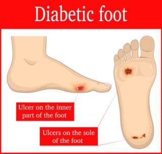 Diabetic Foot Ulcers and Neuropathy