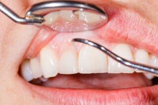 The Silent Dental Disease