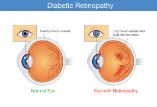 What Is Diabetic Eye Disease?