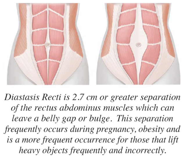 Split Belly Button Conservative Solutions: Pregnancy Related Pelvic and Back Pain ...