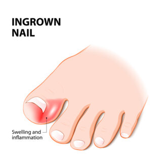 The Ingrown Nail