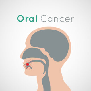 Oral Cancer: Symptoms and Risk Factors