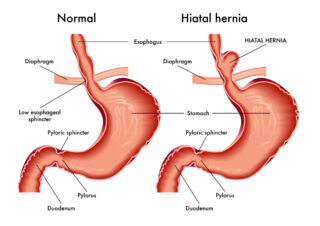 Hiatal Hernia: A Common Cause For Heartburn