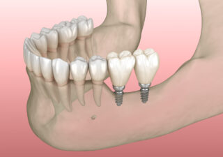 Immediate Mini Dental Implants