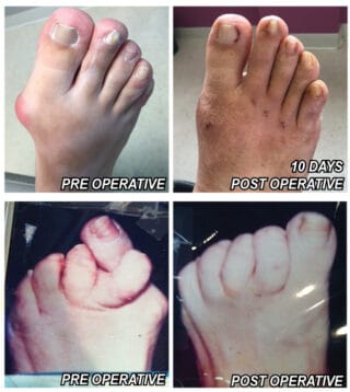Minimally Invasive Foot Surgery – Permanent Cure For Bunions, Hammertoes and Calluses