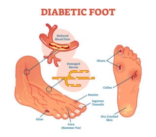 Foot Care For Diabetes: Part Two
