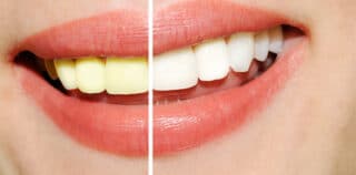 What Is Tooth Whitening?