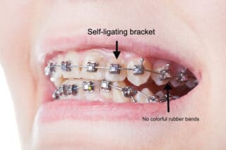 “Self-Ligating” Braces: State-Of-the-Art Orthodontics