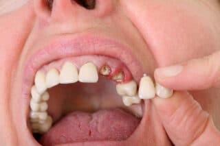 Avoid Failed Dental Implants