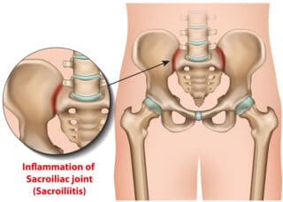 SI Joint Pain and Treatment Options
