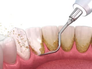 Gum Disease and Soft Tissue Management