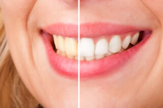 Teeth Whitening: Enhance the Beauty Of Your Smile