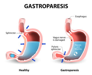 What In the World Is Gastroparesis?