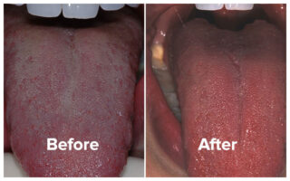 Original Tongue Rejuvenation Permanently Cures Chronic Bad Breath
