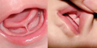 Treating Lip and Tongue-Ties