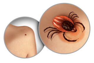 Lyme Disease: How Do I Limit My Exposure To Ticks?