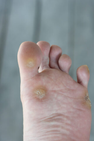 Corns and Calluses: Part One