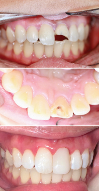 Bioclear – A Very Conservative Approach In Preserving Tooth