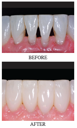Preserve Your Teeth With The Bioclear Method