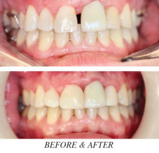 Closing the Gaps For a Youthful Smile