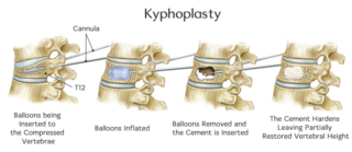 Kyphoplasty: Treatment For Spinal Compression Fractures