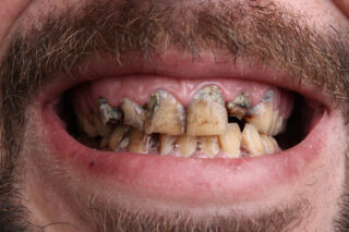 <strong>15 Diseases Caused by Poor Dental Hygiene</strong>