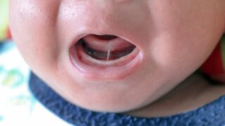 How Pediatric Dentists Use the Latest Technology to Treat Tongue Ties in Children