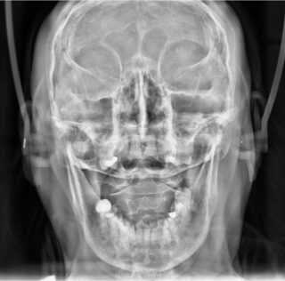The Silent Suffering: <strong><em>Recognizing and Treating the Root Cause of TMJ Pain</em></strong>
