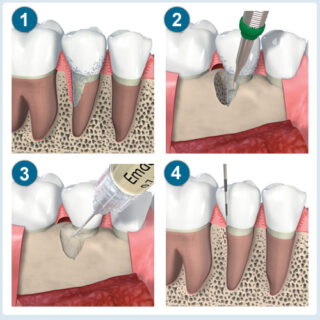 Dental Tissue Regeneration for Hard and Soft Tissues