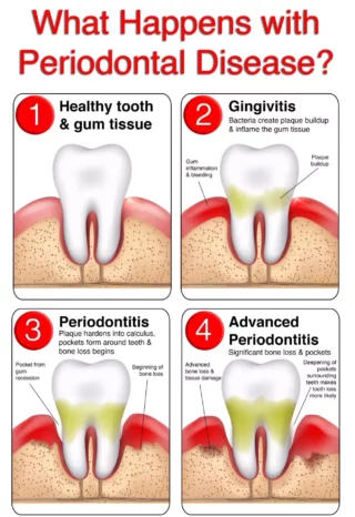 Understanding Periodontal Disease: Causes, Symptoms, and Treatment Options