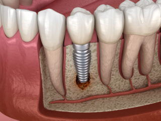 Peri-Implantitis: Understanding and Preventing Implant Complications