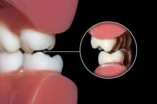 Occlusal Adjustments and Their Role in Preventing Periodontal Disease