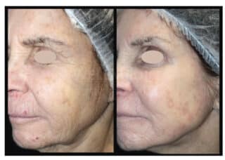 <strong>UltraClear Laser Can Correct Numerous Skin Concerns</strong>