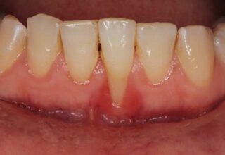 Understanding Muco-Gingival Defects and Gingival Recession