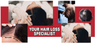 <strong>Everything You Need to Know About Platelet-Rich Plasma Treatment for Hair Loss</strong>