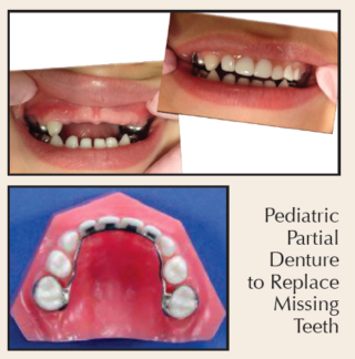 Pedi Partials For Upper Anterior Teeth Replacement: Reasons and Benefits