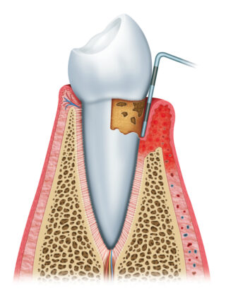 Low Dose Doxycycline Therapy: A Promising Approach to Enhance Periodontal Dental Health