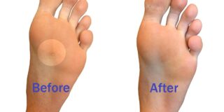 Plantar Warts and Treating Them In-Office With Hydrozid®