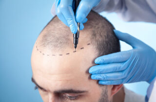 Understanding and Embracing Hair Replacement Therapies