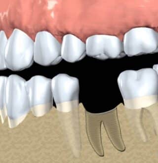 Exploring Hard Tissue Augmentation in Periodontal Dental Health